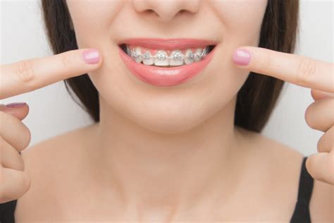 desventajas de los brackets metalicos|brackets de metal.